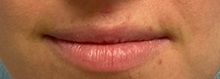 Dermal Fillers Before Photo by Julia Spears, MD, FACS; ,  - Case 50649
