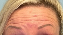 Botulinum Toxin Before Photo by Julia Spears, MD, FACS; ,  - Case 50651