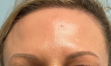 Botulinum Toxin After Photo by Julia Spears, MD, FACS; ,  - Case 50651