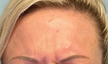 Botulinum Toxin Before Photo by Julia Spears, MD, FACS; ,  - Case 50651