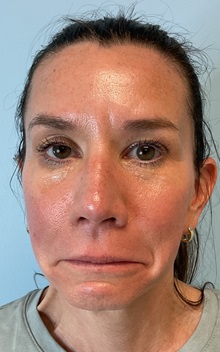 Botulinum Toxin After Photo by Julia Spears, MD, FACS; ,  - Case 50693