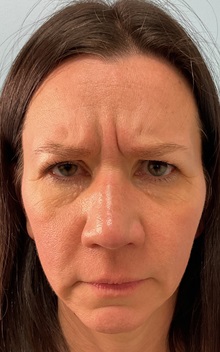 Botulinum Toxin Before Photo by Julia Spears, MD, FACS; ,  - Case 50693