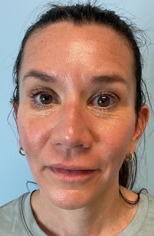 Botulinum Toxin After Photo by Julia Spears, MD, FACS; ,  - Case 50693