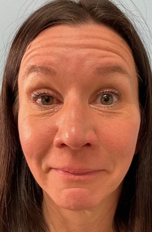 Botulinum Toxin Before Photo by Julia Spears, MD, FACS; ,  - Case 50693