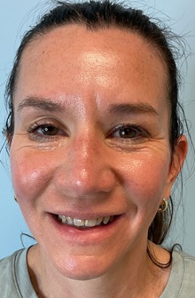 Botulinum Toxin After Photo by Julia Spears, MD, FACS; ,  - Case 50693