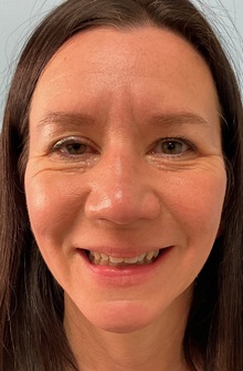 Botulinum Toxin Before Photo by Julia Spears, MD, FACS; ,  - Case 50693