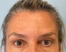 Botulinum Toxin After Photo by Julia Spears, MD, FACS; ,  - Case 50695