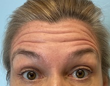 Botulinum Toxin Before Photo by Julia Spears, MD, FACS; ,  - Case 50695