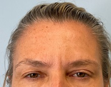 Botulinum Toxin After Photo by Julia Spears, MD, FACS; ,  - Case 50695