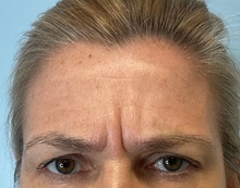 Botulinum Toxin Before Photo by Julia Spears, MD, FACS; ,  - Case 50695
