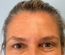 Botulinum Toxin After Photo by Julia Spears, MD, FACS; ,  - Case 50695