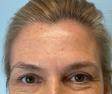 Botulinum Toxin Before Photo by Julia Spears, MD, FACS; ,  - Case 50695