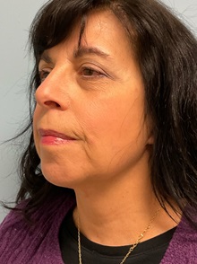 Neck Lift After Photo by Julia Spears, MD, FACS; ,  - Case 50698