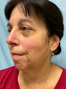 Neck Lift Before Photo by Julia Spears, MD, FACS; ,  - Case 50698