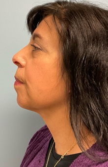 Neck Lift After Photo by Julia Spears, MD, FACS; ,  - Case 50698