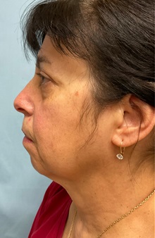Neck Lift Before Photo by Julia Spears, MD, FACS; ,  - Case 50698