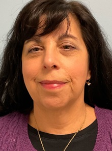 Neck Lift After Photo by Julia Spears, MD, FACS; ,  - Case 50698