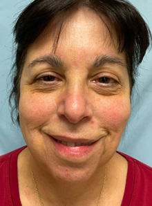 Neck Lift Before Photo by Julia Spears, MD, FACS; ,  - Case 50698