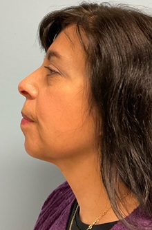 Facelift After Photo by Julia Spears, MD, FACS; ,  - Case 50697