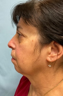 Facelift Before Photo by Julia Spears, MD, FACS; ,  - Case 50697