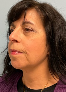 Facelift After Photo by Julia Spears, MD, FACS; ,  - Case 50697
