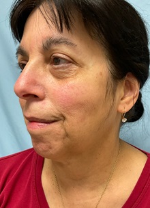 Facelift Before Photo by Julia Spears, MD, FACS; ,  - Case 50697