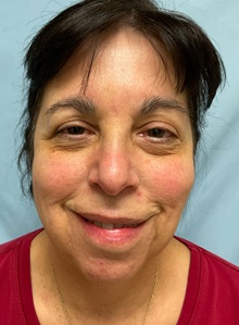 Facelift Before Photo by Julia Spears, MD, FACS; ,  - Case 50697