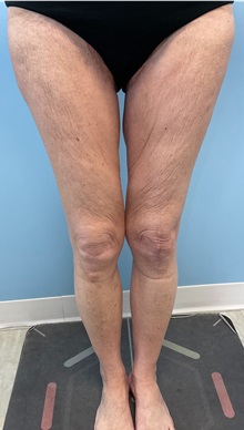 Thigh Lift After Photo by Julia Spears, MD, FACS; ,  - Case 50699