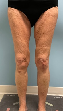 Thigh Lift Before Photo by Julia Spears, MD, FACS; ,  - Case 50699