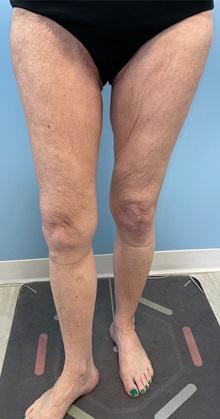 Thigh Lift After Photo by Julia Spears, MD, FACS; ,  - Case 50699