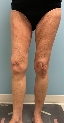 Thigh Lift Before Photo by Julia Spears, MD, FACS; ,  - Case 50699