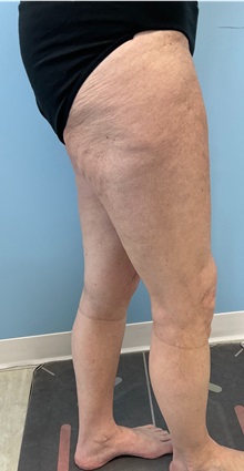 Thigh Lift After Photo by Julia Spears, MD, FACS; ,  - Case 50699