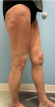 Thigh Lift Before Photo by Julia Spears, MD, FACS; ,  - Case 50699