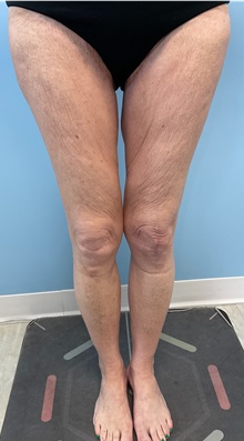 Liposuction After Photo by Julia Spears, MD, FACS; ,  - Case 50701
