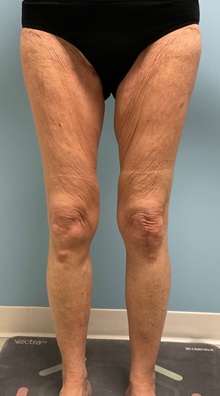Liposuction Before Photo by Julia Spears, MD, FACS; ,  - Case 50701