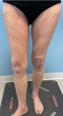 Liposuction After Photo by Julia Spears, MD, FACS; ,  - Case 50701