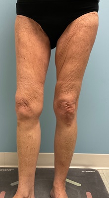 Liposuction Before Photo by Julia Spears, MD, FACS; ,  - Case 50701