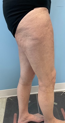 Liposuction After Photo by Julia Spears, MD, FACS; ,  - Case 50701