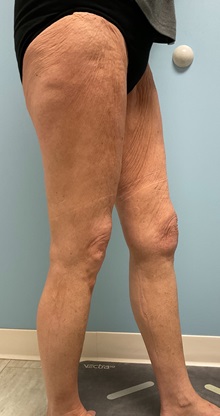 Liposuction Before Photo by Julia Spears, MD, FACS; ,  - Case 50701