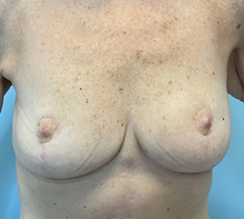 Breast Lift After Photo by Julia Spears, MD, FACS; ,  - Case 50702