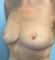 Breast Lift After Photo by Julia Spears, MD, FACS; ,  - Case 50702