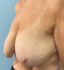 Breast Lift Before Photo by Julia Spears, MD, FACS; ,  - Case 50702