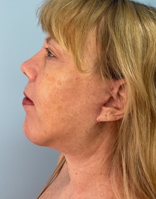 Neck Lift After Photo by Julia Spears, MD, FACS; ,  - Case 50705