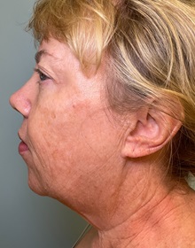 Neck Lift Before Photo by Julia Spears, MD, FACS; ,  - Case 50705