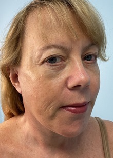 Neck Lift After Photo by Julia Spears, MD, FACS; ,  - Case 50705