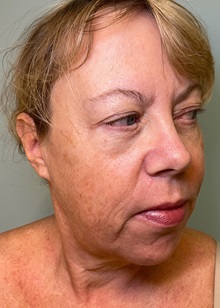 Neck Lift Before Photo by Julia Spears, MD, FACS; ,  - Case 50705
