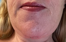 Neck Lift After Photo by Julia Spears, MD, FACS; ,  - Case 50705