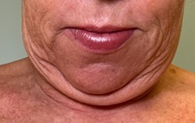 Neck Lift Before Photo by Julia Spears, MD, FACS; ,  - Case 50705