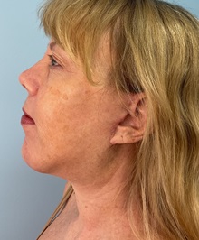 Chin Augmentation After Photo by Julia Spears, MD, FACS; ,  - Case 50706