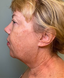 Chin Augmentation Before Photo by Julia Spears, MD, FACS; ,  - Case 50706